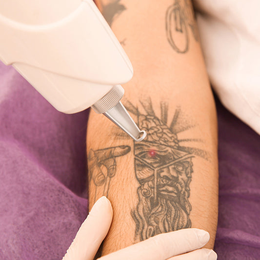 Remoção de tatuagem
