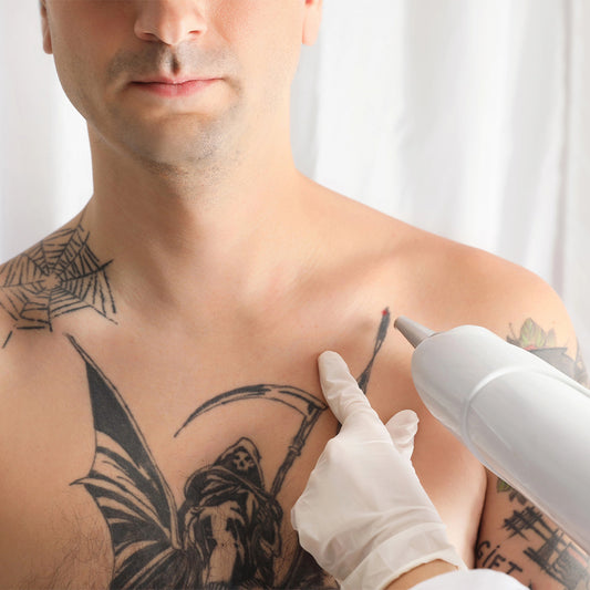 Remoção de tatuagem