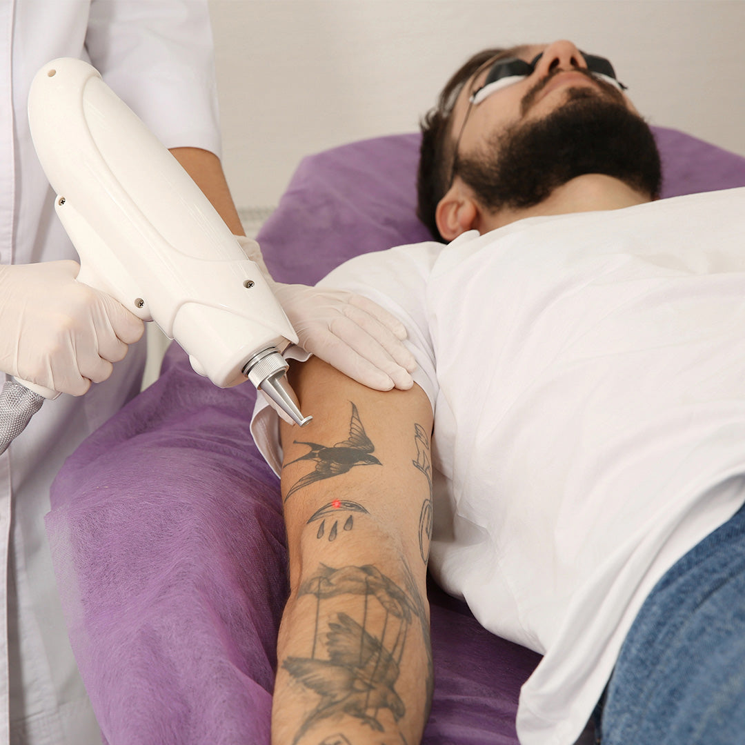 Remoção de tatuagem